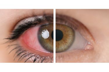 anterioruveitis_adobestock_248413869