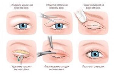 blefaroplastika