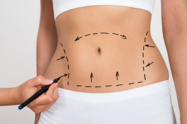 abdominoplastika